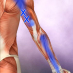 Bl 1 Triceps 1 trp