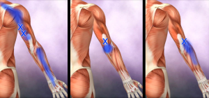 Bl 2 Triceps trp
